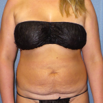 Abdominoplasty Before & After Patient #2156