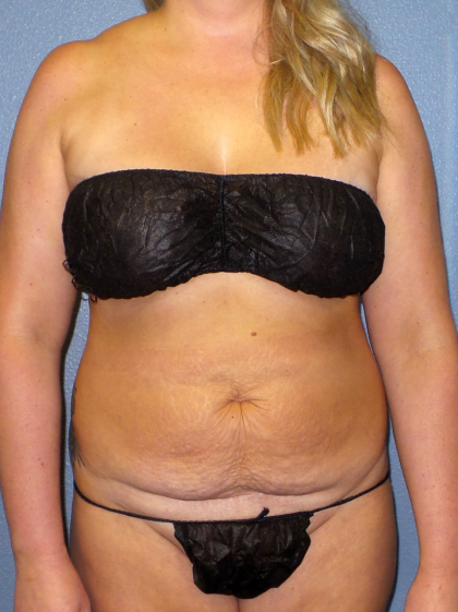 Abdominoplasty Before & After Patient #2156