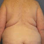 Liposuction Female Before & After Patient #1240