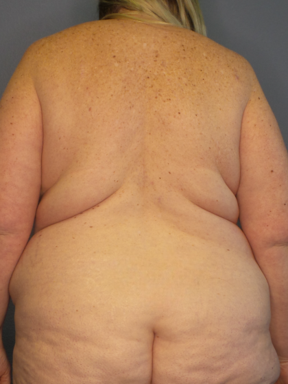 Liposuction Female Before & After Patient #1240
