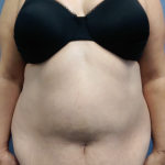 Abdominoplasty Before & After Patient #2102