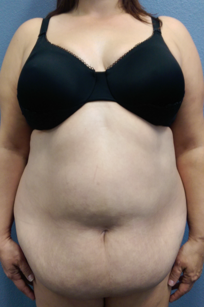 Abdominoplasty Before & After Patient #2102