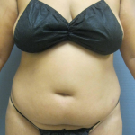 Liposuction Female Before & After Patient #1228