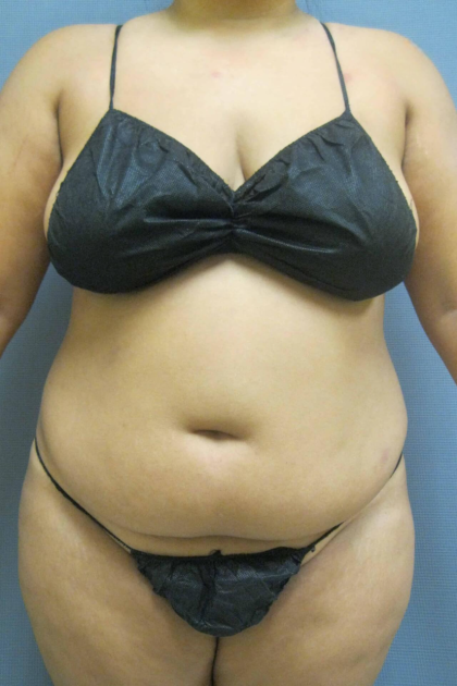 Liposuction Female Before & After Patient #1228