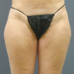 Liposuction Female Before & After Patient #1205