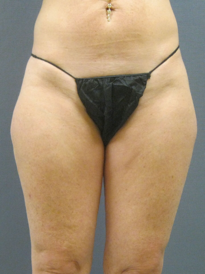 Liposuction Female Before & After Patient #1205