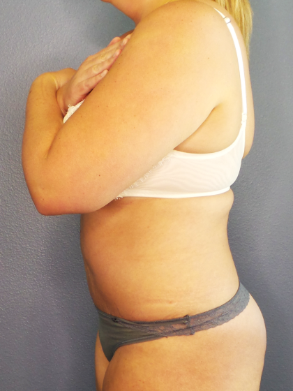 Abdominoplasty Before & After Patient #2156