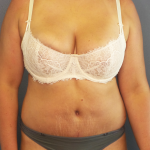 Abdominoplasty Before & After Patient #2156