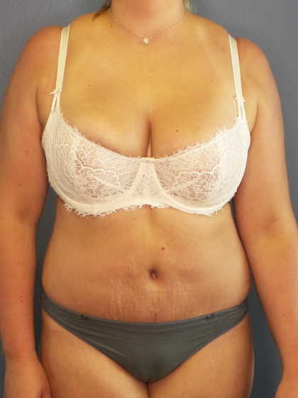 Abdominoplasty Before & After Patient #2156