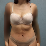 Abdominoplasty Before & After Patient #2145