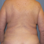 Liposuction Female Before & After Patient #1240