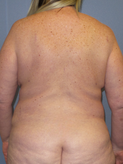 Liposuction Female Before & After Patient #1240