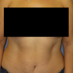 Abdominoplasty Before & After Patient #2102