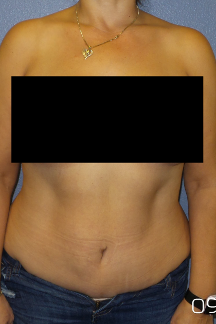 Abdominoplasty Before & After Patient #2102
