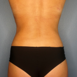 Liposuction Female Before & After Patient #1235