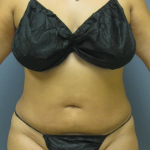 Liposuction Female Before & After Patient #1228