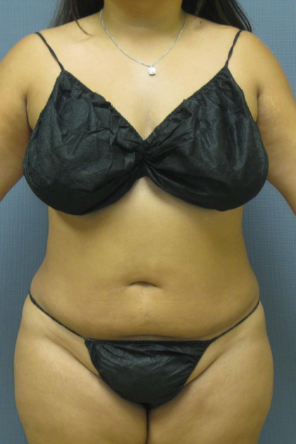 Liposuction Female Before & After Patient #1228