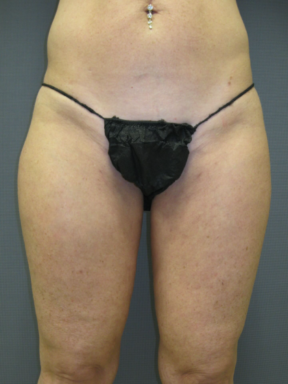Liposuction Female Before & After Patient #1205