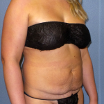 Abdominoplasty Before & After Patient #2156