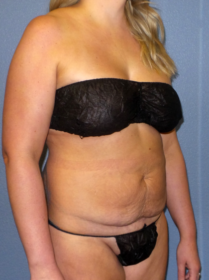 Abdominoplasty Before & After Patient #2156