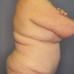 Liposuction Female Before & After Patient #1240