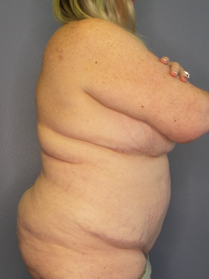 Liposuction Female Before & After Patient #1240