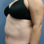 Abdominoplasty Before & After Patient #2102