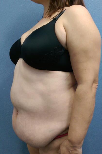 Abdominoplasty Before & After Patient #2102