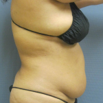 Liposuction Female Before & After Patient #1228