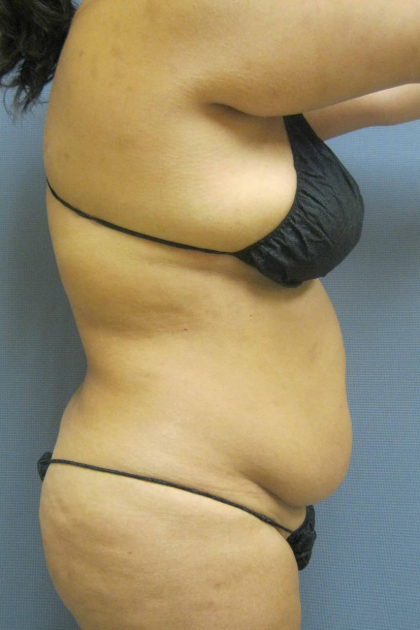 Liposuction Female Before & After Patient #1228