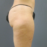 Liposuction Female Before & After Patient #1205