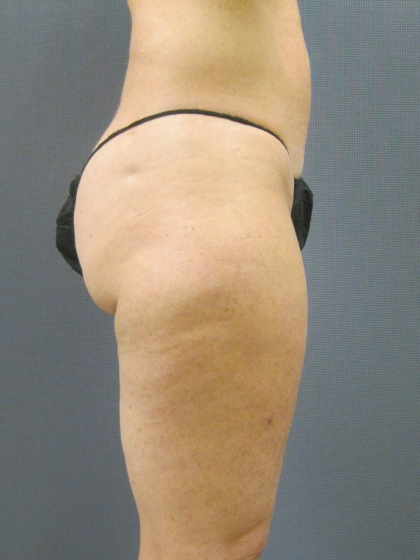 Liposuction Female Before & After Patient #1205