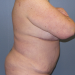 Liposuction Female Before & After Patient #1240
