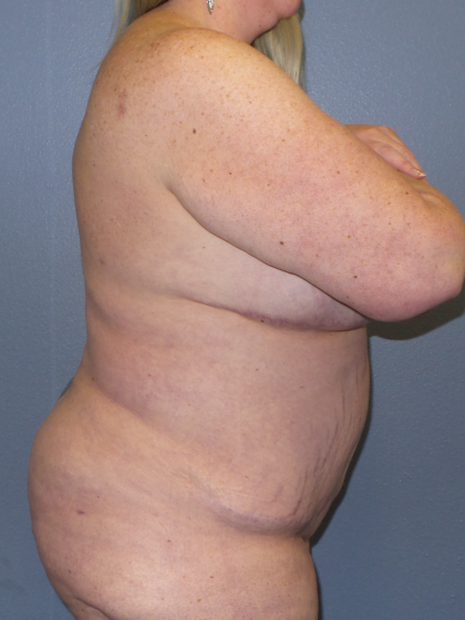 Liposuction Female Before & After Patient #1240