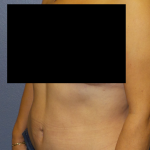 Abdominoplasty Before & After Patient #2102