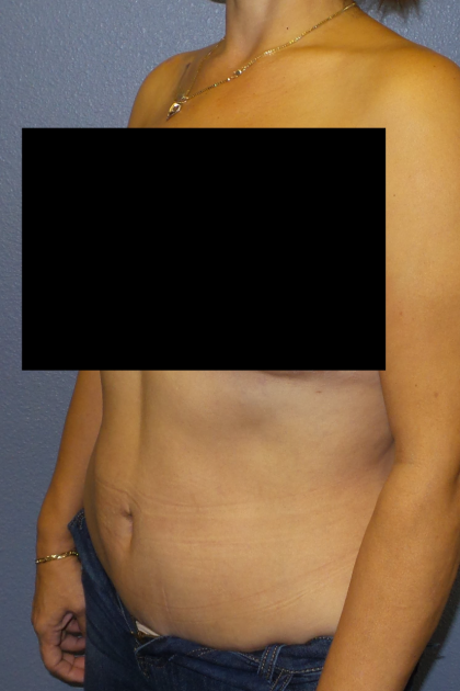 Abdominoplasty Before & After Patient #2102