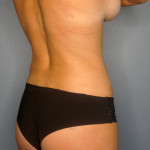 Liposuction Female Before & After Patient #1235