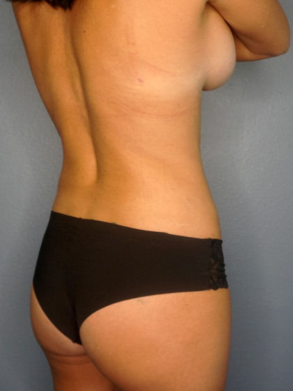 Liposuction Female Before & After Patient #1235