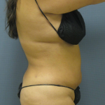 Liposuction Female Before & After Patient #1228