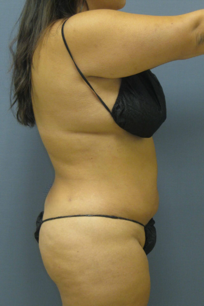 Liposuction Female Before & After Patient #1228