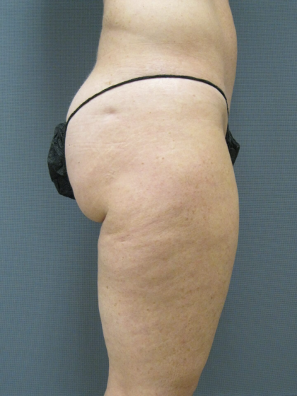 Liposuction Female Before & After Patient #1205