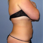 Abdominoplasty Before & After Patient #2156