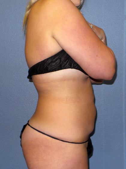 Abdominoplasty Before & After Patient #2156