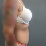 Abdominoplasty Before & After Patient #2145