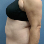 Abdominoplasty Before & After Patient #2102
