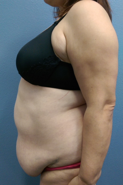 Abdominoplasty Before & After Patient #2102