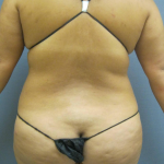 Liposuction Female Before & After Patient #1228