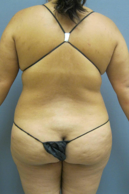 Liposuction Female Before & After Patient #1228