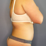 Abdominoplasty Before & After Patient #2156