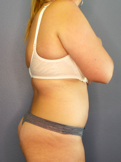 Abdominoplasty Before & After Patient #2156